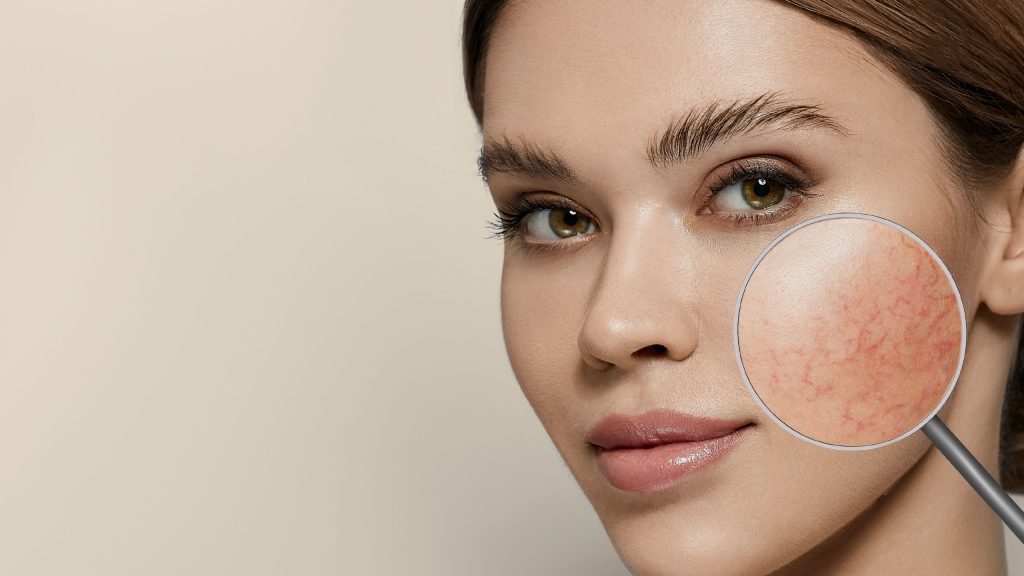 rozaceea - skinmed