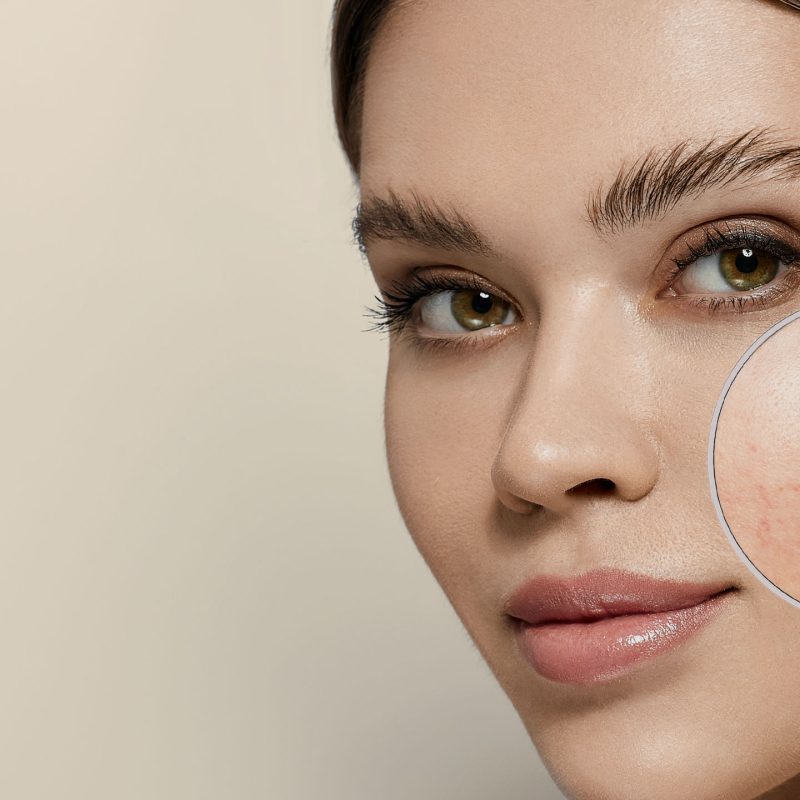 rozaceea - skinmed
