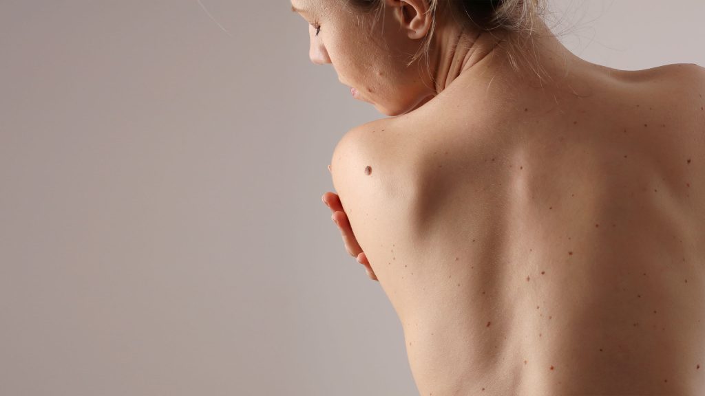 alunite corporale tratament - skinmed clinic