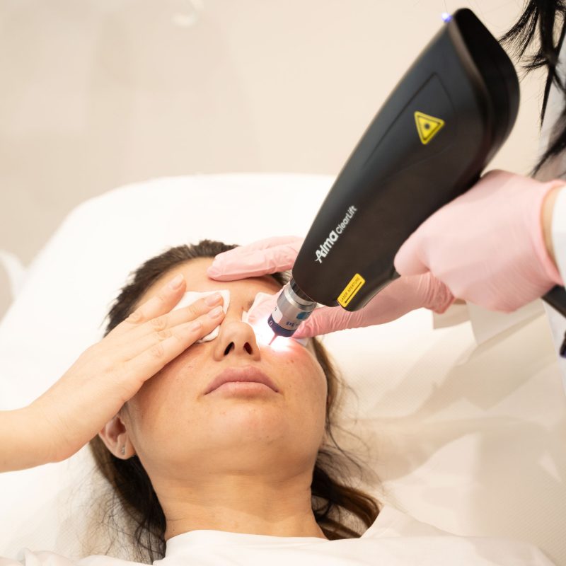 tratament melasma alma clealift skinmed clinic