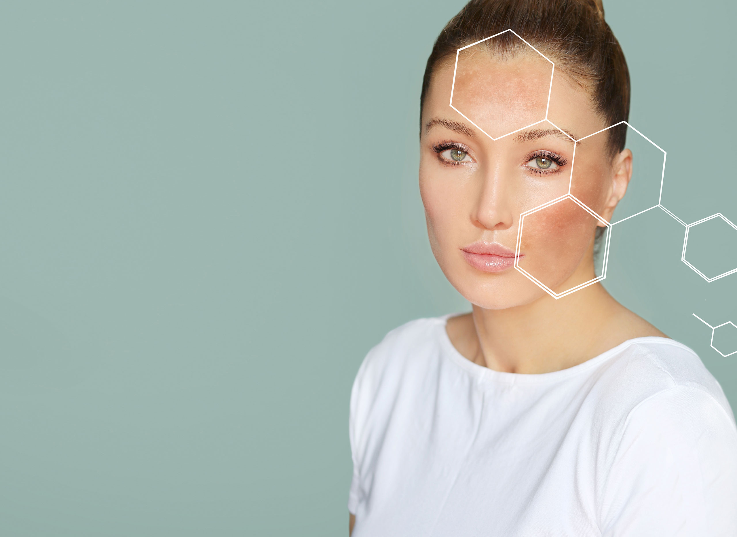 </noscript>Petele care te dau de gol după vară! Ce este melasma și de ce toamna e momentul ideal să scapi de ea?