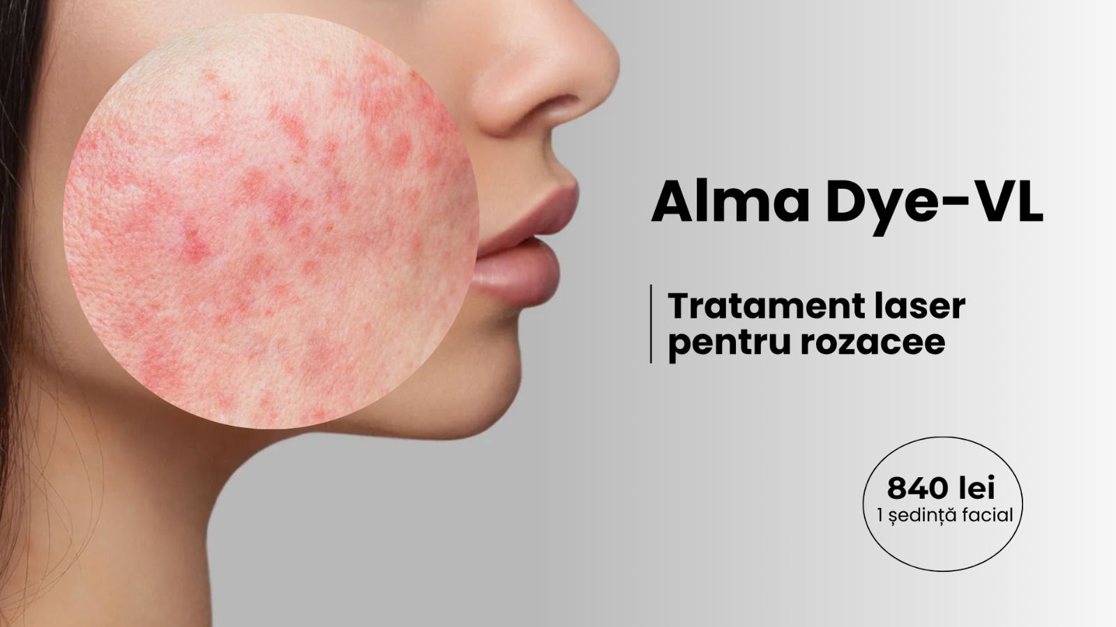 oferta apr 2026 alma dye vl skinmed clinic